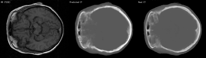 MR, predicted CT, real CT of a human brain